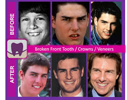 Maybe you would like to learn more about one of these? Celebrity Smiles Revealed Tom Cruise Stouffville Smiles Dentistry