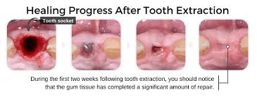 Tooth Extraction Aftercare Instructions The Dos Don Ts