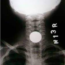 Ekspose 2 (dua) kali dalam satu film dengan posisi tabung yang berbeda. Lateral View X Ray Showing Double Coin In Upper Esophagus Download Scientific Diagram