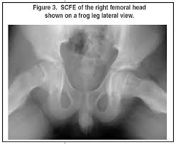 Image result for Pediatric Limp
