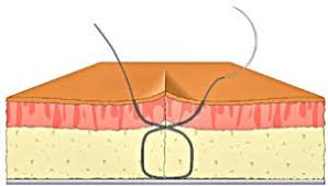 Tying A Figure 8 Suture A Step By Step Illustrative Guide tying a figure 8 suture a step by