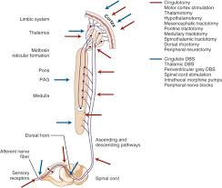 Image result for Thalamic Stimulation