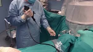 Flexible Ureteroscopy For Proximal Ureteral Stone Youtube