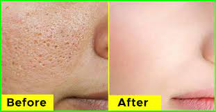 This remedy not only improves your skin's appearance, but it also invigorates you. 20 Home Remedies To Get Rid Of Open Pores On Skin