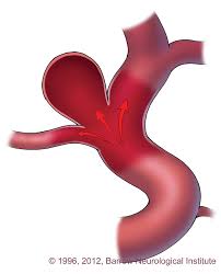 An aneurysm is a weak point in a blood vessel wall, most commonly in an artery. What Is An Aneurysm Joe Niekro Foundation