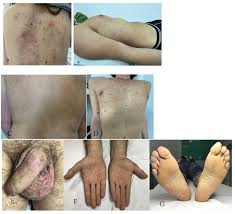 Image result for syphilis symptoms