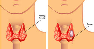 But as it grows, it can cause pain and swelling. Thyroid Cancer Causes Symptoms Treatment Prevention