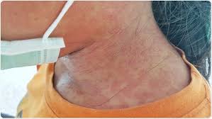 Image result for Rubella