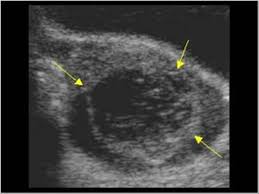These cysts can range from the size of a pea to an orange, but most ovarian cysts are small and harmless. Gynaecology 3 2 Adnexa Case 3 2 1 Benign Cystic Lesions Ultrasound Cases