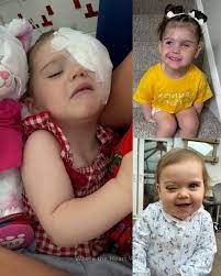At just 14 months old, Ava was diagnosed with retinoblastoma, a rare  childhood eye cancer. Her tumour filled her entire eye, and to save her  life, it had to be removed. Since