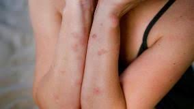 Image result for bedbugs bites