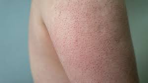 Image result for Keratosis pilaris