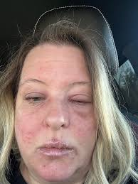 Have been dealing with this since November. Prescribed Hydrocortisone 2.5%,  didn't work, then prescribed Prednisone and a shot, didn't work, now a  third prescription which seems to have been helping so far