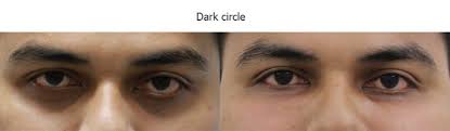 Nanofat Como Tratamiento Para Eliminar Ojeras Oscuras Mirada Feliz