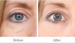 The top countries of supplier is china, from which the percentage. Dark Circle Under Eye Treatment Lighttouch Med Spa