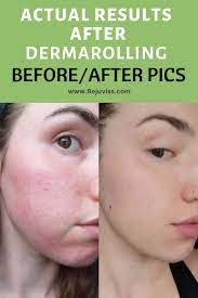 Actual Results After Dermarolling With Before After Pics Derma Roller Derma Rolling Derma Roller Results