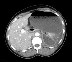 Image result for Volvulus