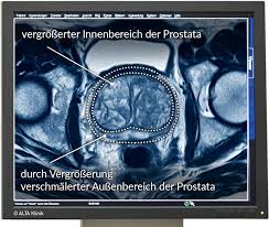 Anatomie, funktion, geschlechtshormone und krankheitszeichen. Prostatavergrosserung Symptome Behandlung Therapie Alta Klinik