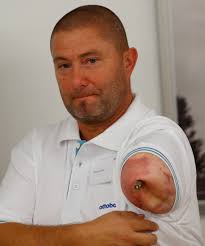 Click-on bionic arm could help amputees do the simple things