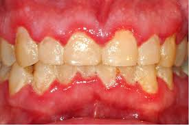 Image result for Gingivitis