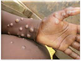 There have been two cases of monkeypox identified in north wales, health officials have said. Monkeypox