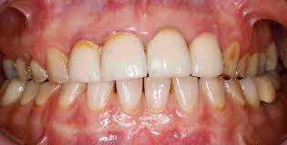 Image result for Tooth Attrition