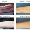 The laser tattoo removal price increases by appx. 1