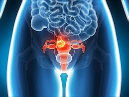 If you have not yet been through the menopause, abnormal bleeding may include very heavy periods or bleeding between your periods. Womb Cancer Is On The Rise Experts Warn The Signs You Need To Know