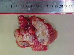 Primary occurrence in the liver has been demonstrated for . Macroscopic Appearance Of Benign Cystic Mesothelioma With Thin Walled Download Scientific Diagram