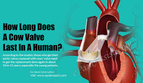 The valve replaces a damaged or malfunctioning mitral valve in your heart. How Long Does A Cow Valve Last In A Human