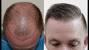 Hair Transplant Results Month By Month