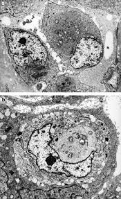 The same method has now been applied to a . Mesothelioma With Rhabdoid Features An Ultrastructural And Immunohistochemical Study Of 10 Cases Modern Pathology