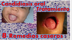 Candidiasis Oral Tratamiento 8 Remedios Caseros Youtube