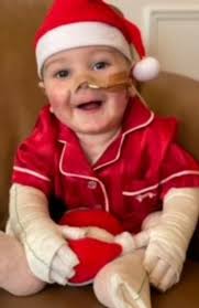 The first thing I saw when he was born was skin missing from his leg'