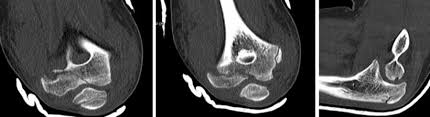 Image result for Lateral Condyle Fracture