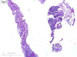 Image result for Acute Pyelonephritis