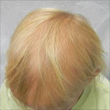 Ash blonde is an appealing color that can make your image extremely stylish. Hereditary Hypotrichosis Simplex Of The Scalp Mdedge Dermatology