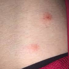 Doch wenn sie das problem erkennen, können sie in wenigen schritten und etwas geduld den floh im bett wieder loswerden. Was Sind Das Fur Stiche Bisse Auf Meinem Korper Haut Insekten Stich