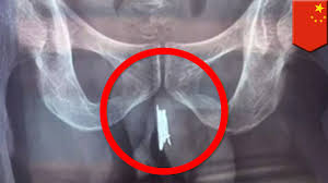 Tabiat ini boleh dianggap sebagai salah satu teknik foreplay bagi memberikan senaman sebelum bersetubuh dan memanaskan tubuh isteri agar lebih bersedia. Cara Memasukan Kelamin Pria Ke Kelamin Wanita Nasi