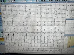 Image result for Extrasystole