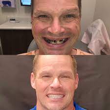 Your dental implants dentist will tell you that your implants are free and this may well be the case however have you asked your dental implants dentist about any labor costs? All On 4 Teeth In A Day Memphis Dentures And Implants