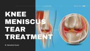 Maybe you would like to learn more about one of these? Will Walking On A Torn Meniscus Make It Worse Archives Dr Ramakant Kumar