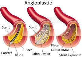 Stresul, lipsa de calciu şi spasmosfilia, efortul fizic şi intelectual intens, dar şi mesele copioase pot provoca înţepături. Angioplastia Si Stentul Vascular Proceduri Medicale