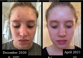 Acne and pigmentation solutions available