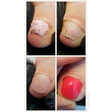 Toenail Reconstruction Before And After I Used Polygel And Gelpolish Acrylic Nails At Home Toe Nails Nails