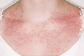 Foley m.r., strong т.н., garite t.j., eds. Patients At Risk Of Anaphylaxis Gponline