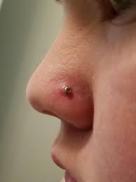 First Facial Piercing 2 5 Months Old It S Not Painful And Draining Next To Nothing The Swelling Was Much Less Noticeable But In A Larger Area Yesterday It All Moved Closer To