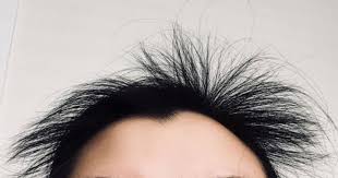 Some women may experience hair loss after stopping a hormonal birth control method, so you are not alone if this happens to you. Postpartum Hair Growth Struggles October 2018 Birth Club Babycenter Canada
