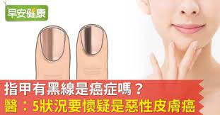 縱向黑甲症 指甲基質生長板的黑色素細胞 處在靜止期 當黑色素細胞開始活躍 啟動黑色素合成 指甲就會出現線條 依黑色素多寡 從淡灰 棕色 到深黑 淡淡的灰線 通常是良性的黑色素細胞活化 臨床需要判斷是黑色素細胞活化 斑 良性增生痣 或甲床下黑