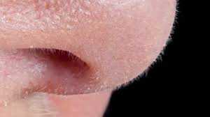 Bonjour, je viens de lire des témoignages et des questions sur les carcinomes baso cellulaires. Sentir Le Cancer En Clinique Bien Avant L Apparition Des Symptomes Rci Francais
